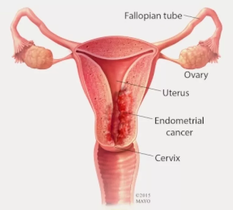 Cercetatorii de la Mayo Clinic (SUA) testeaza un nou tampon capabil sa detecteze cancerul de uter