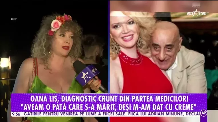 Oana Lis, diagnosticata cu cancer de piele!