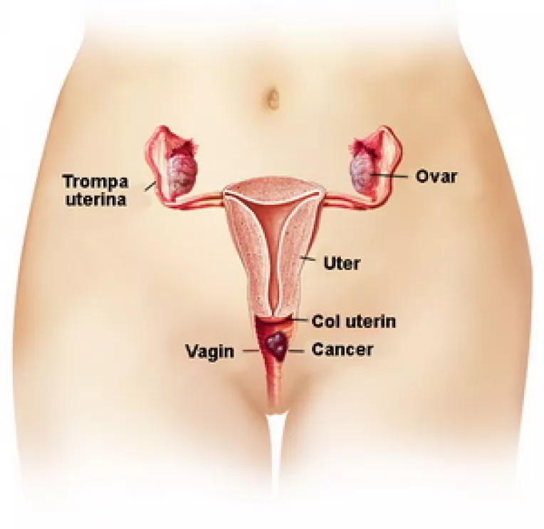 Vaccin pentru prevenirea leziunilor genitale precanceroase de col uterin, vulva si de vagin, precum si a cancerului de col uterin